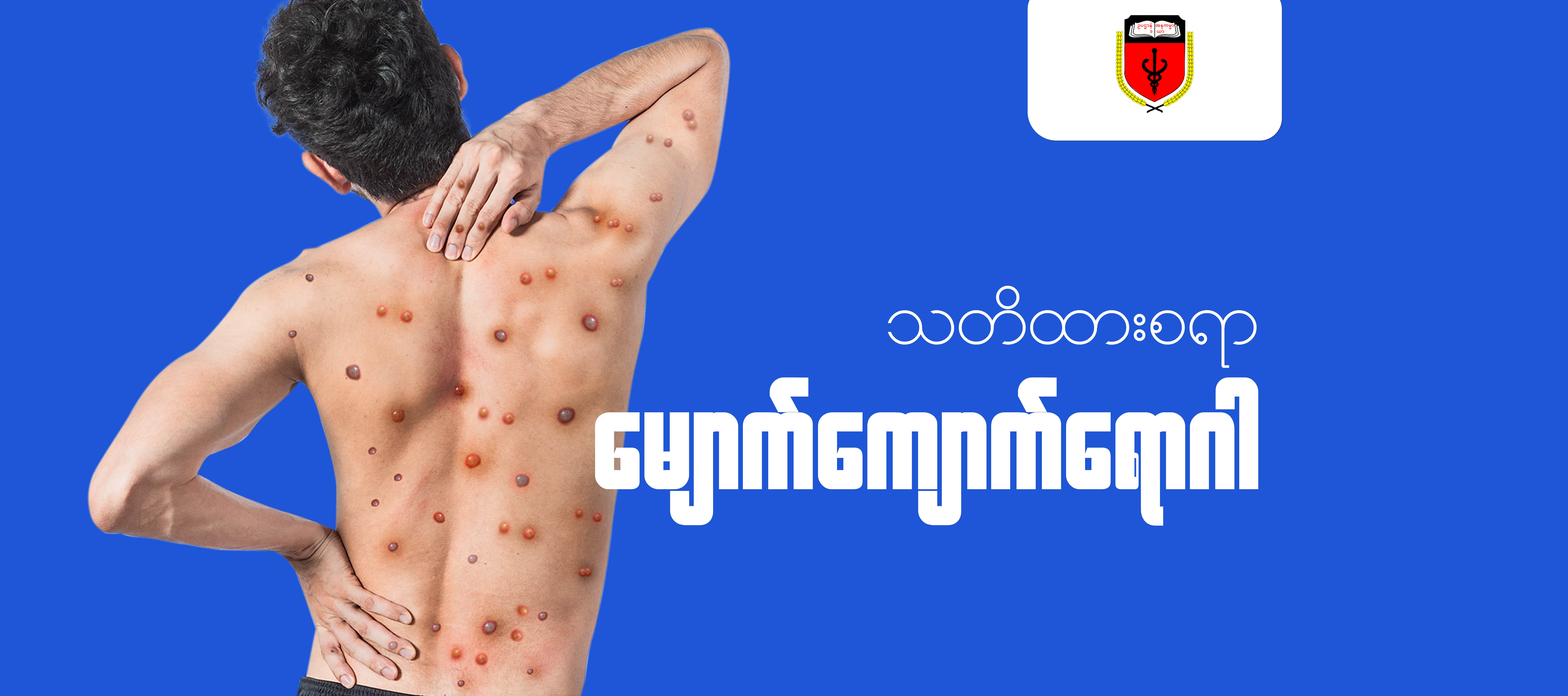 "မျောက်ကျောက်ရောဂါ - Monkeypox” အကြောင်းသိကောင်းစရာ MS004